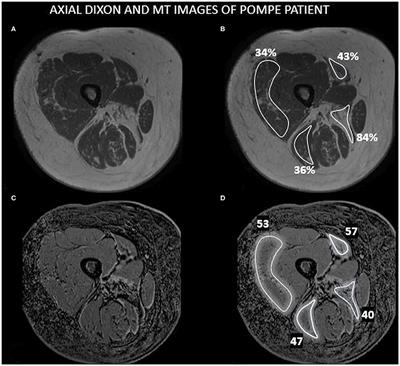 Magnetization Transfer Ratio in Lower Limbs of Late Onset Pompe Patients Correlates With Intramuscular Fat Fraction and Muscle Function Tests